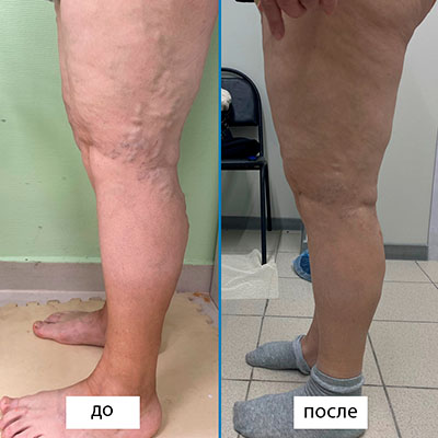 Результаты лазерного лечения варикоза