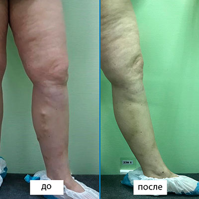 Результаты лазерного лечения варикоза