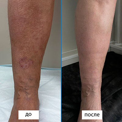 Результаты лечения трофической язвы и варикоза лазером (ЭВЛК БПВ). Между фото 22 дня.