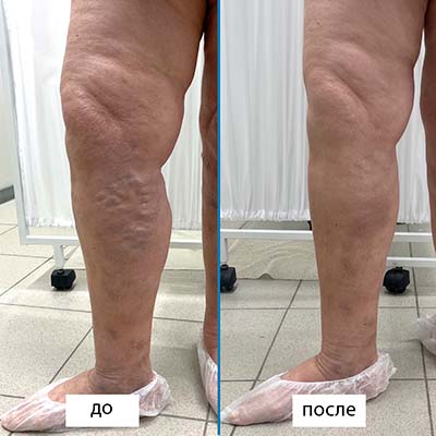 Результат лазерного лечения варикоза большой подкожной вены на левой ноге