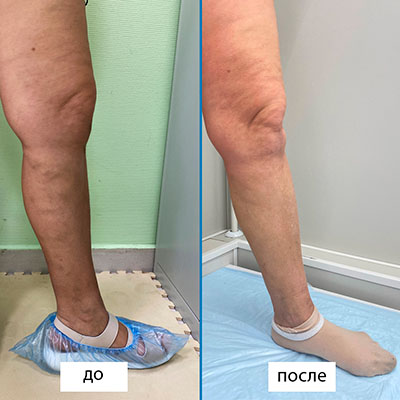 Лазерное лечение (ЭВЛК) большой подкожной вены слева