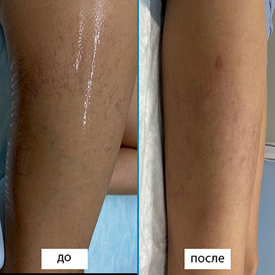 Результаты склеротерапии. Разница между фото 1,5 мес.